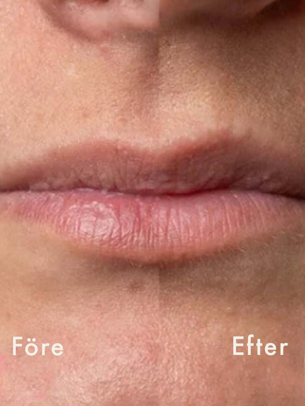 Läppar före och efter Trew Peel Lip